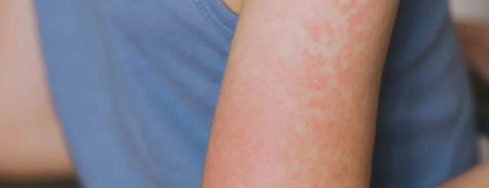 L’ambassade des Pays-Bas recommande la vaccination avant le voyage au Maroc